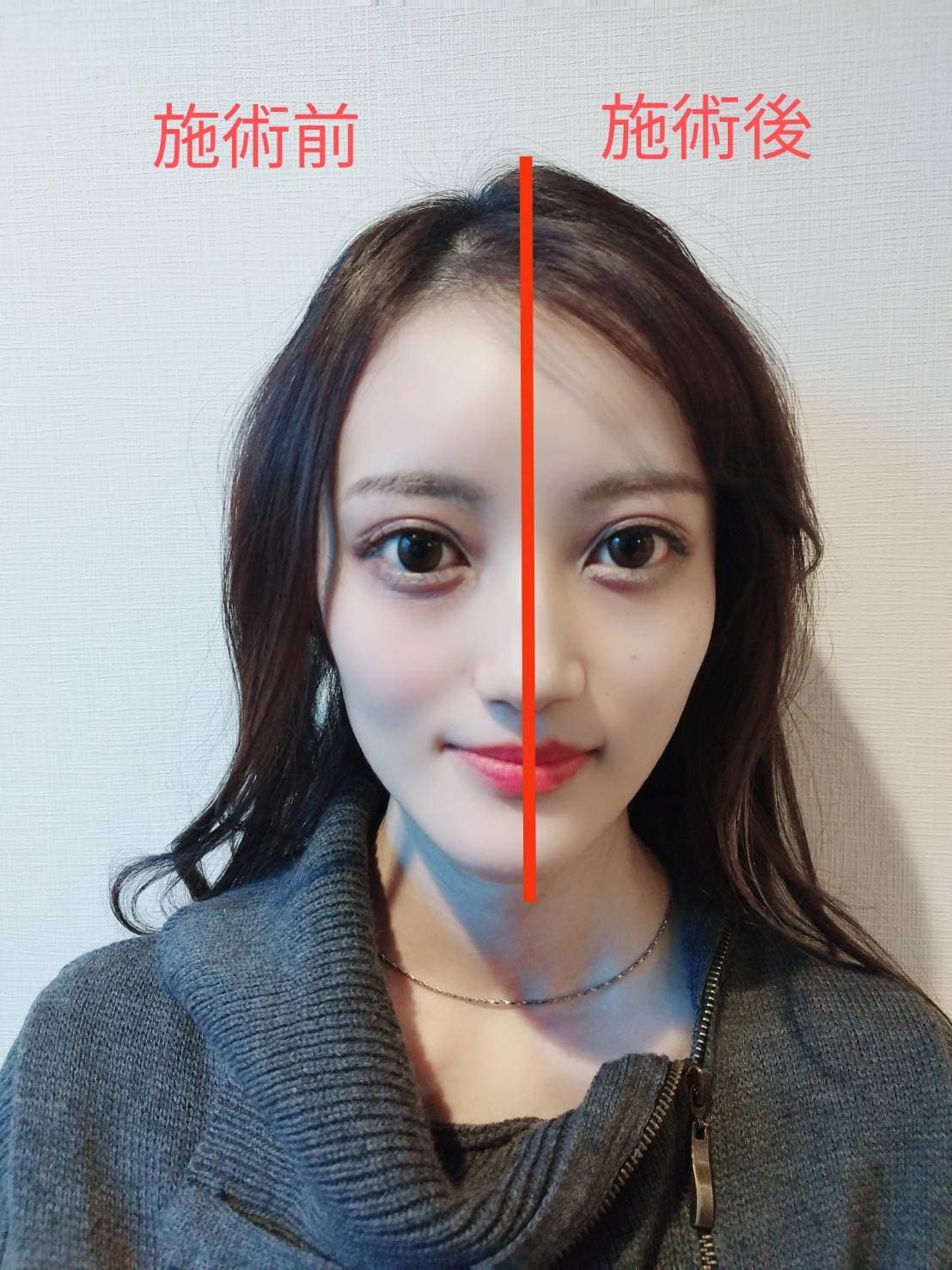 リフトアップ/小顔効果 Before After
