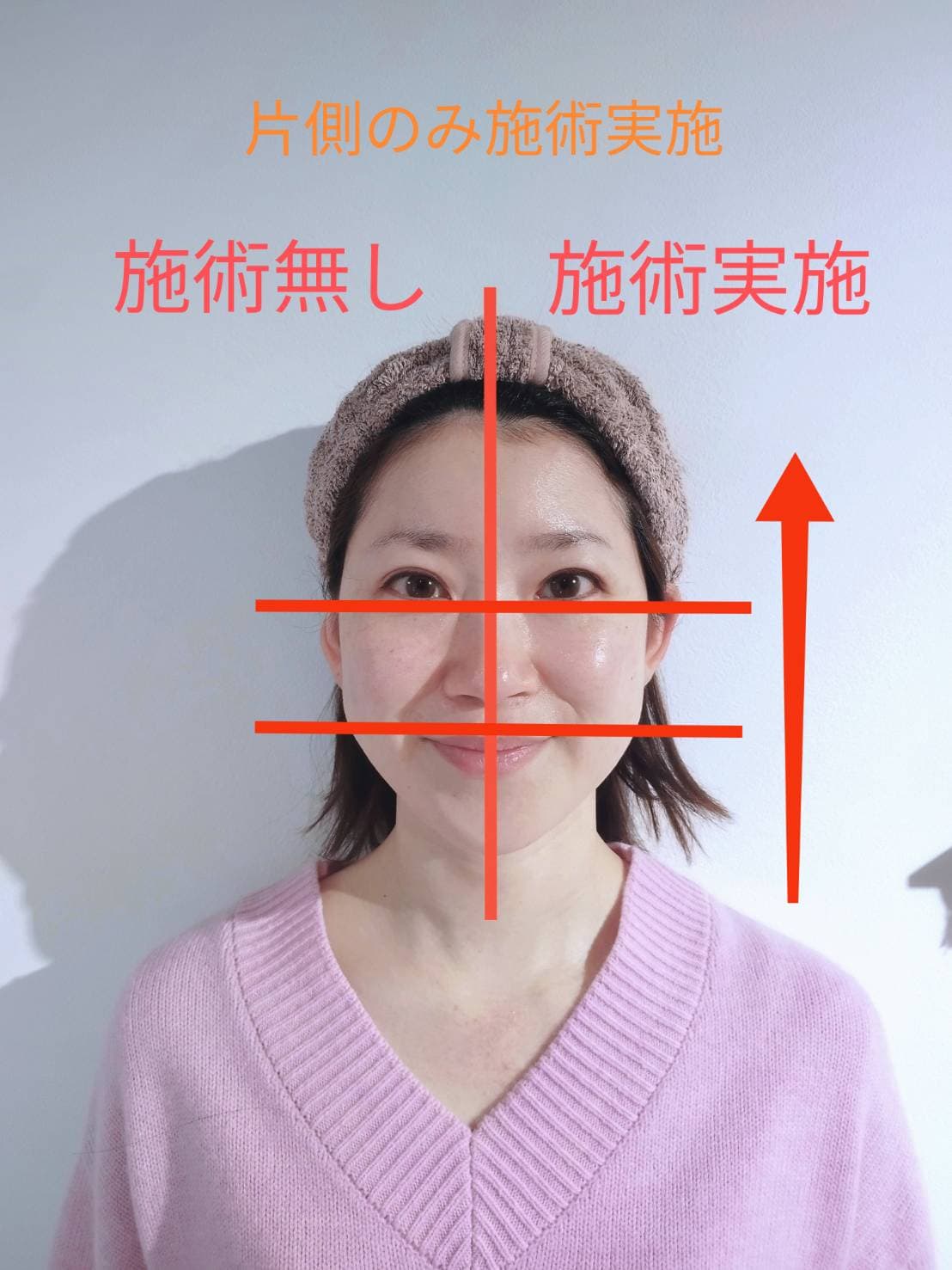 フェイスライン・たるみ改善 Before After